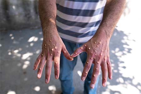 man with monkeypox blisters on his hands